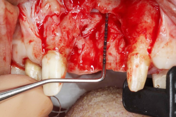 Intraoperative Darstellung des Knochendefekts regio 21/22 mit Messsonde