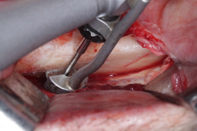 Entnahme des retromolaren Knochenblocks mit der MicroSaw