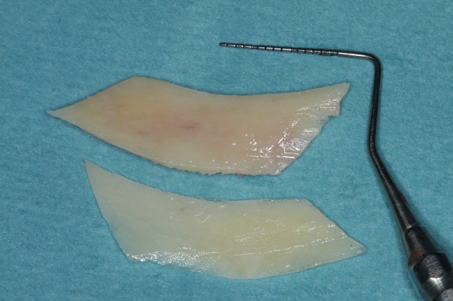 Retromolarer Knochenblock, mit der MicroSaw in zwei gleich große Knochenschalen geteilt
