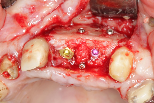 Implantatinsertion nach drei Monaten mit Nachaugmentation durch lokal gewonnenen Knochen