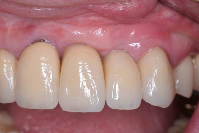 Klinisches Ergebnis sechs Jahre nach prothetischer Versorgung der Implantate 21 und 22