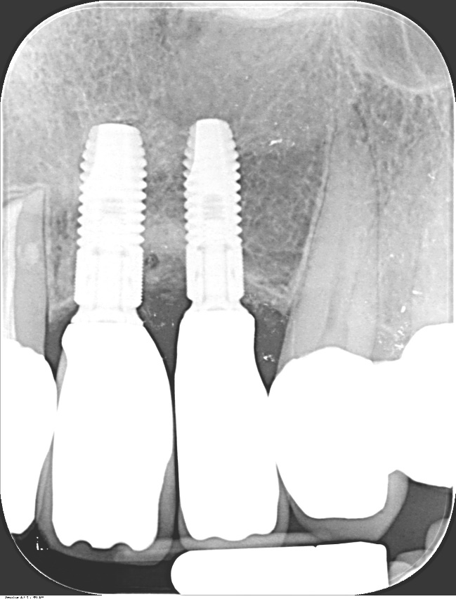 Einzelzahn-Röntgenaufnahme sechs Jahre postoperativ mit stabilen periimplantären Knochenverhältnissen